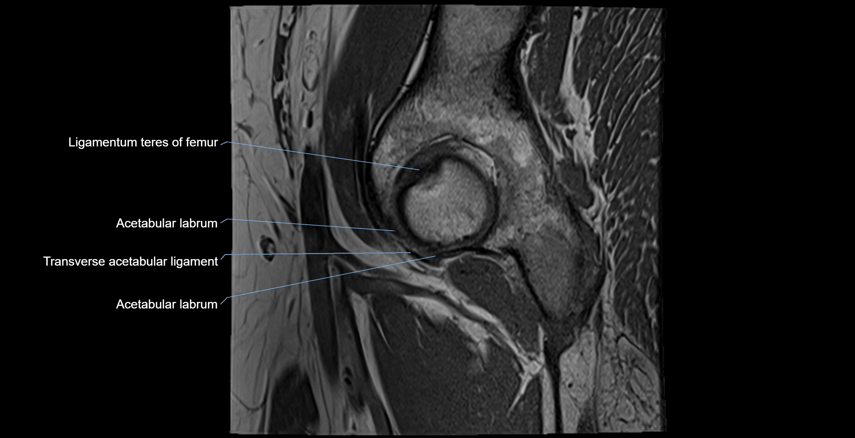 MRI Hip ligaments sagittal cross sectional anatomy 3T  radiology  image-img-00001-00005.webp